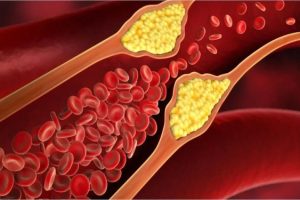 The Cholesterol Problem